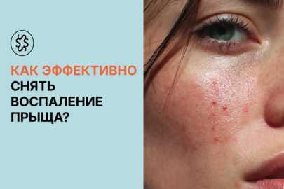  Как эффективно снять воспаление прыща 