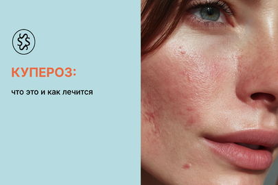 Купероз: что это и как лечится