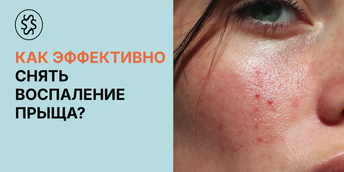  Как эффективно снять воспаление прыща 
