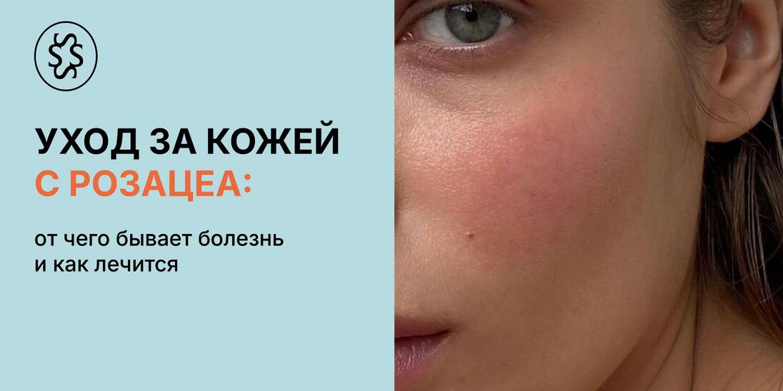 Уход за кожей при розацеа: от чего бывает болезнь и как лечится