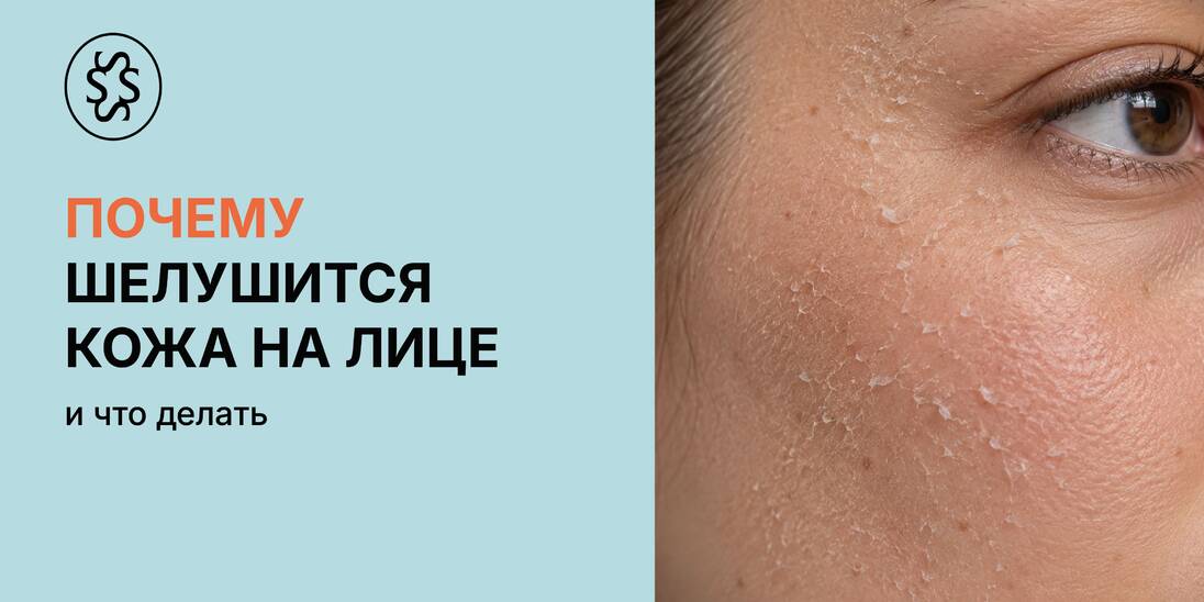 Почему шелушится кожа на лице и что делать