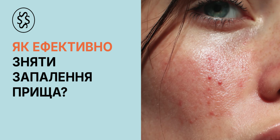 Як ефективно зняти запалення прища?